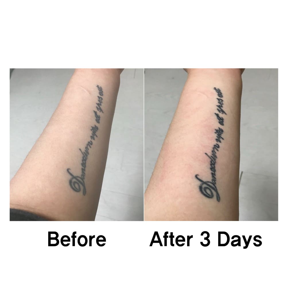 Laser Tattoo Removal Lausanne Picosure - Before After